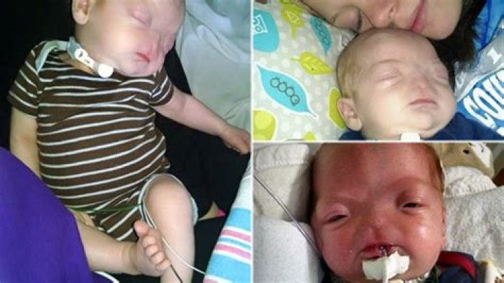 Eli Thompson: Meet The Very Cute Baby Who Was Born Without A Nose