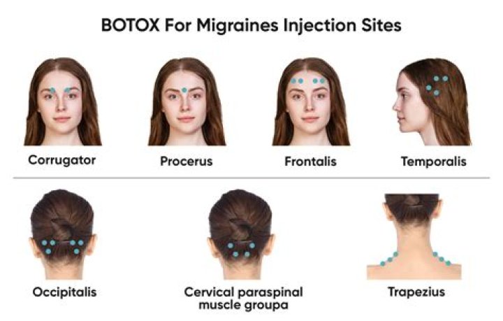 Botox For Migraines: Chrissy Teigen & More Celebrity Supporters