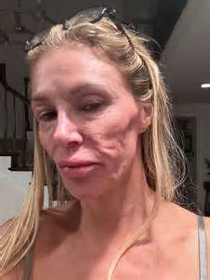 Brandi Glanville’s Terrifying Laser Hair Removal Saga: It Paralyzed Half My Face