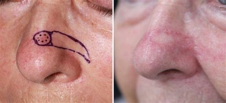 Caitlyn Jenner Reveals She Had Skin Removed & ‘Reattached’ From Her Nose After Cancer Scare