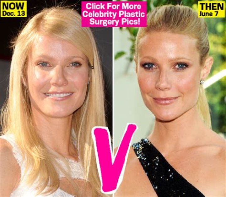 Fillers, Botox & Laser Treatments Gave Gwyneth Paltrow Her Puffy New Face! – Hollywood Life