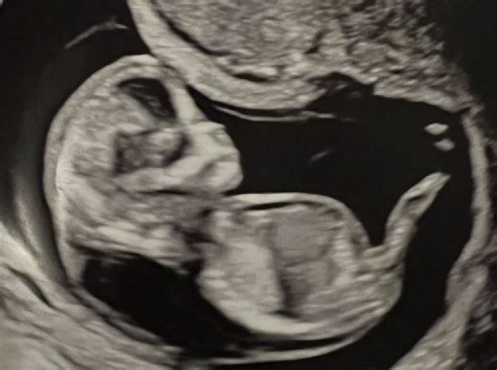 New Baby Ultrasound May Show Something’s Wrong – Hollywood Life