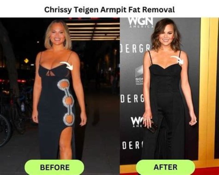 Chrissy Teigen Got Armpit Liposuction — What Is It & Should You Try It?