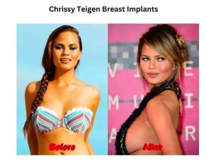 Chrissy Teigen Confesses She’s Having Her Implants Removed: ‘I’m Just Over It’