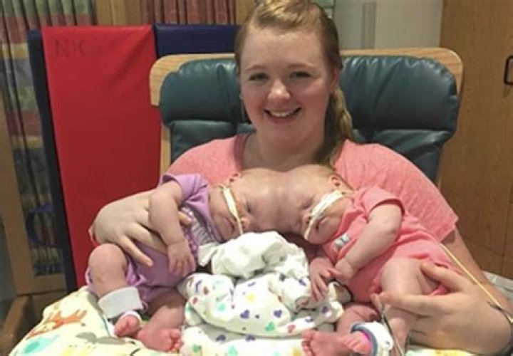 [PICS] Conjoined Twins Erin & Abby Delaney – Hollywood Life