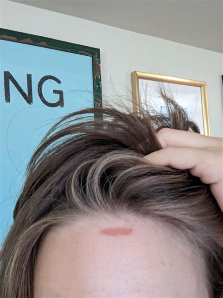 Curling Iron Burn — How To Treat & Heal A Burn From A Hot Hair Tool – Hollywood Life