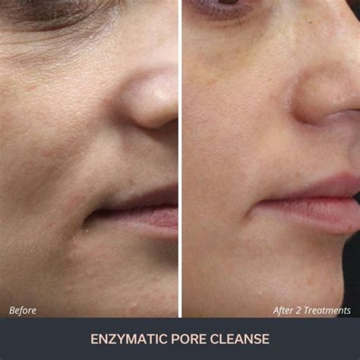 Highest-Rated Enzyme Peel of 2023 – Hollywood Life Reviews – Hollywood Life