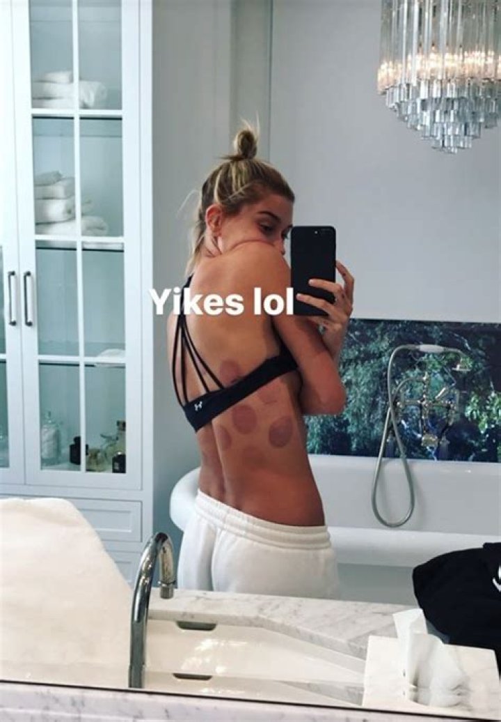 Hailey Baldwin Does Cupping — Should You The Treatment? Expert Tips – Hollywood Life