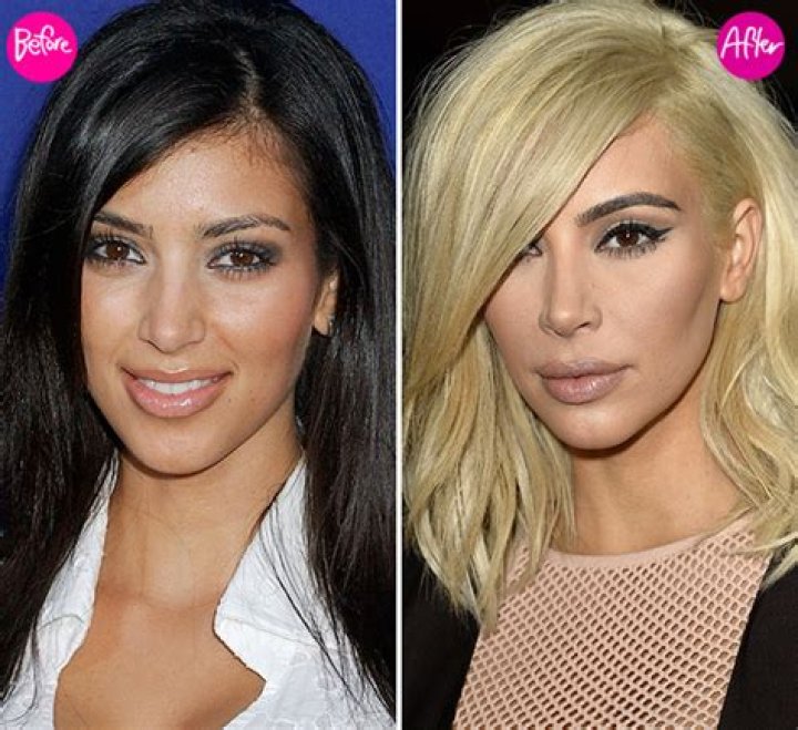 Kardashians’ Lips: Bruce Jenner & More Before & After Photos