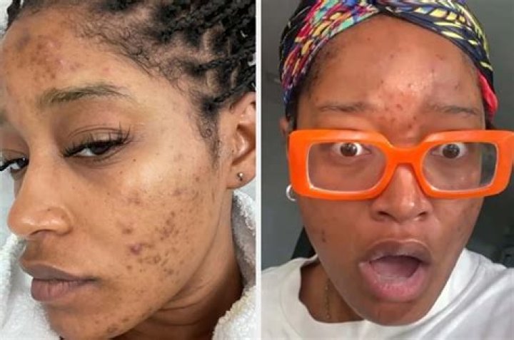 Keke Palmer Reveals Acne After Polycystic Ovarian Syndrome Diagnosis – Hollywood Life