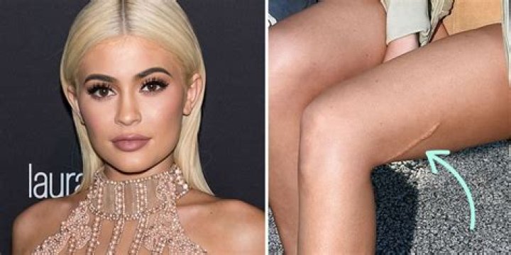 [PICS] Kylie Jenner’s Scar Is On Full Display In New Photo — See Pic – Hollywood Life