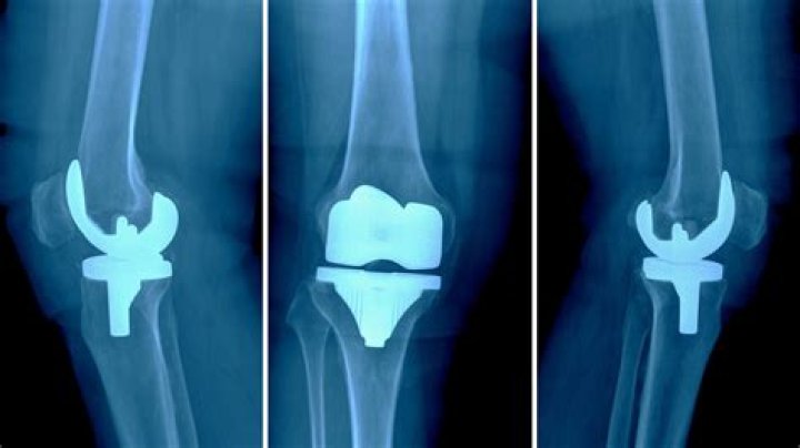 Knee Replacement Surgery To Blame? — Doctor Speaks – Hollywood Life